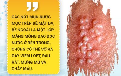 Mọc mụn nước ở bao quy đầu là bệnh gì? [ CHUYÊN GIA GIẢI ĐÁP]