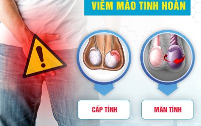Viêm mào tinh hoàn: Nguyên nhân, dấu hiệu & cách chữa