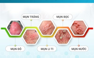 Bao quy đầu có mụn đỏ cảnh báo bệnh nam khoa nguy hiểm
