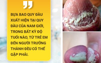 Bựa bao quy đầu cẩn thận biến chứng 5 bệnh nam khoa nguy hiểm