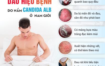Nấm dương vật và những điều nam giới cần biết