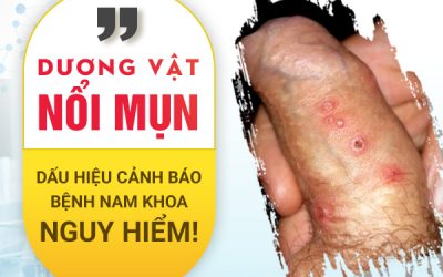 Dương vật nổi mụn: Dấu hiệu cảnh báo bệnh nam khoa nguy hiểm!