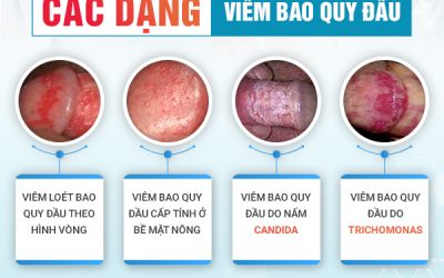 Hiểu đúng nguyên nhân, dấu hiệu viêm bao quy đầu để hỗ trợ chữa hiệu quả