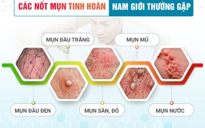 Tinh hoàn nổi mụn cẩn thận mắc bệnh sùi mào gà