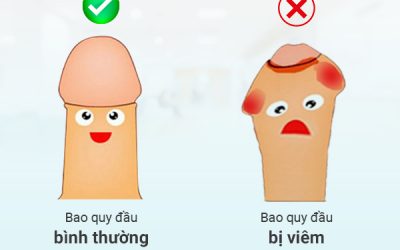 Biểu hiện viêm bao quy đầu kèm hình ảnh chi tiết nhất