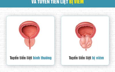 Bệnh viêm tuyến tiền liệt và những điều cần biết